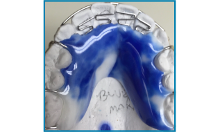 Blueberry Marbled retainer